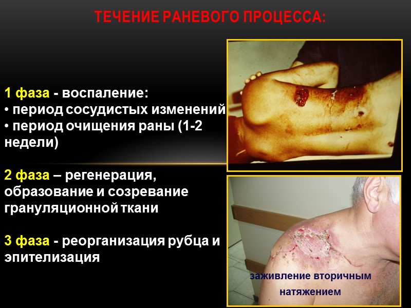 ТЕЧЕНИЕ РАНЕВОГО ПРОЦЕССА: 1 фаза - воспаление:  период сосудистых изменений  период очищения